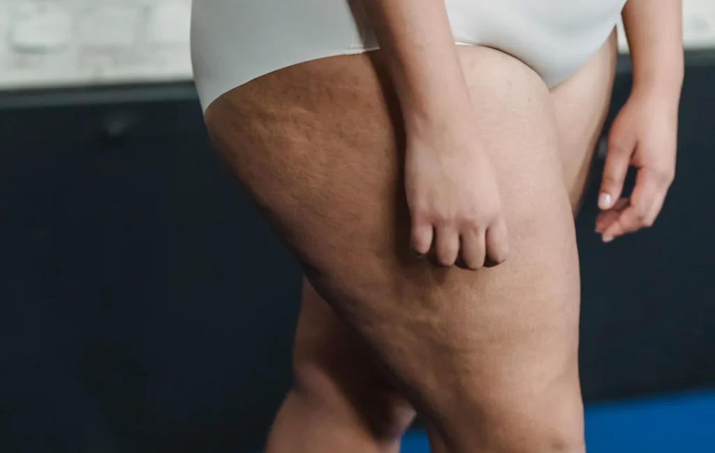 lipedema e alimentazione