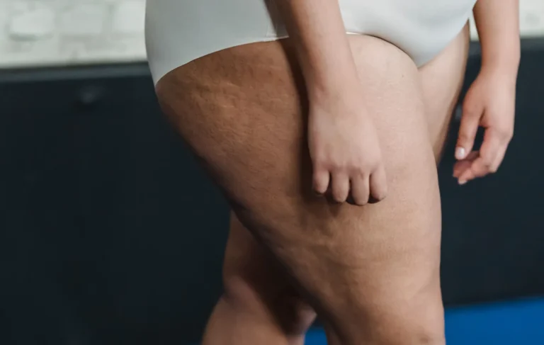 lipedema e alimentazione